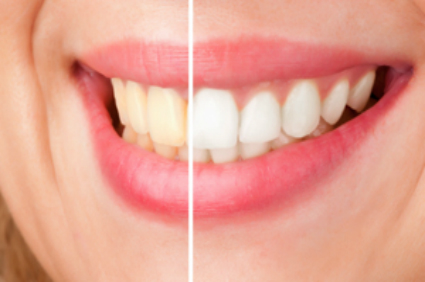 teeth whitening before and after