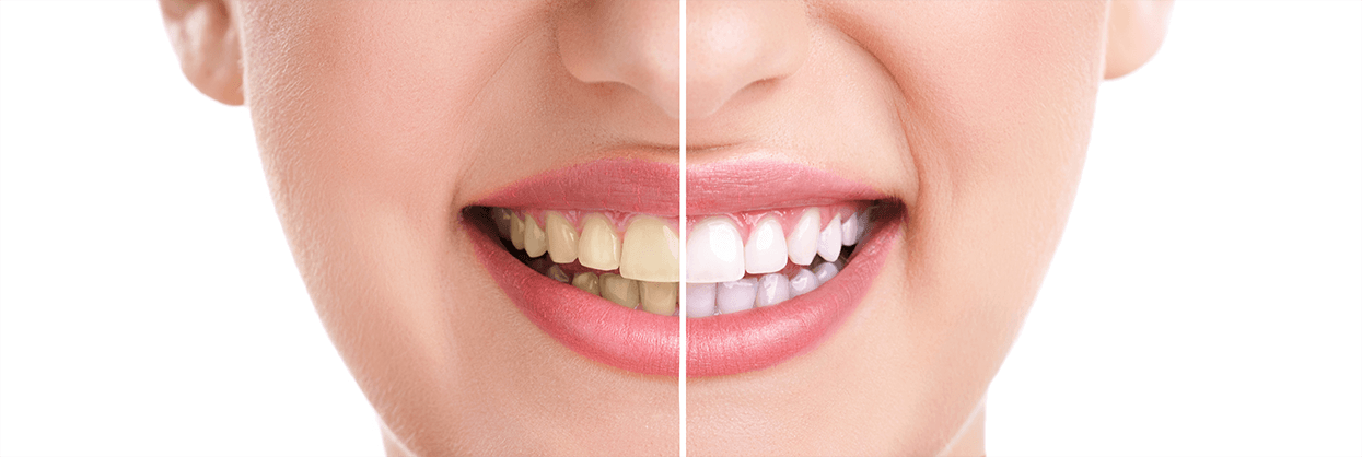 Teeth Whitening in Woodridge, Illinois